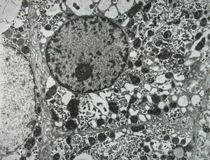 M,7y. | Wilson disease susp. M,7y. | Wilson disease susp.